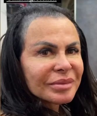 Gretchen revela avanço da alopecia, fala sobre tratamento e avalia transplante capilar - Imagem do artigo