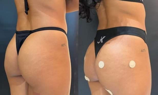 Bella Campos adota lace e faz procedimento nos glúteos 15 dias após última mudança de visual - Imagem do artigo original